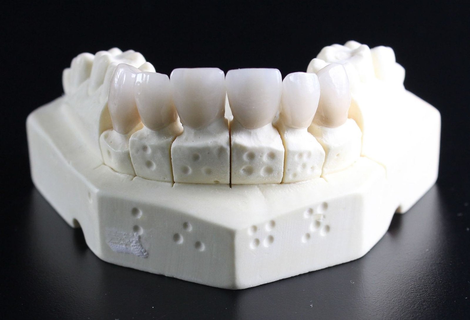 A dental model showing porcelain crowns, one of the urgent repairs we can connect you with in Orlando
